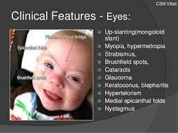 Epicanthic folds is a skin fold on the upper eyelid which covers the inner angle of the eye, which makes them appear smaller and more slanted, even if the eye itself is no different from an eye with no epicanthic fold. Down Syndrome