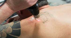 However, you can go through a pain chart and prepare your. Is Laser Tattoo Removal More Painful Than Getting A Tattoo Fresh Skin Canvas