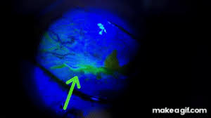 Image result for Seidel Test