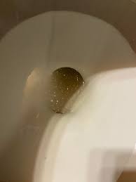 What Makes Your Pee Like This Passed Previous Stones Have Intermittent Pain In Urethra When Peeing Kidneystones