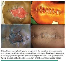 The unique contribution of oswaldo a. Negative Pressure Wound Therapy Compared To Petrolatum Gauze And A Bogota Bag To Manage Postoperative Midline Abdominal Wound Dehiscence A Pilot Nonrandomized Controlled Trial