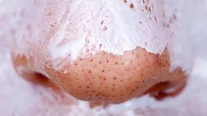 They arent raised at all and dont hurt or. Those Tiny Black Dots On Your Face Aren T Blackheads So Um What Are They Stellar