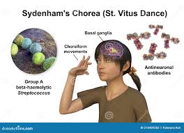 Image result for Chorea