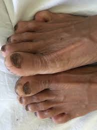 Image result for Koilonychia feet