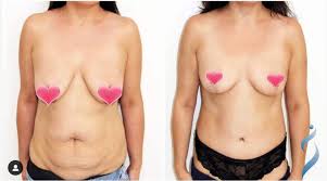 Check spelling or type a new query. What Does A Tummy Tuck Cost In Australia Costhetics