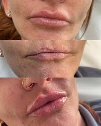 Lip Filler: Dissolve And Re-Fill