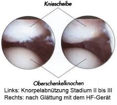 Knorpelschaden Knorpelschaden Michael Vitek Dr Prof Inv Uag Universidad Autonoma Guadalajara Villahermosa Tabasco Mexico