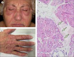 We did not find results for: Classification And Management Of Adult Inflammatory Myopathies The Lancet Neurology