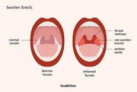 Swollen Tonsils: Tonsillitis, Symptoms, Causes, And More