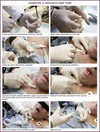Image result for Tracheostomy