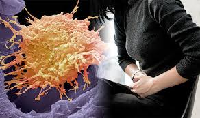 The most common cervical cancer warning is abnormal vaginal bleeding. Cervical Cancer Symptoms Seven Signs It S Become Advanced Here S How To Test For It Express Co Uk