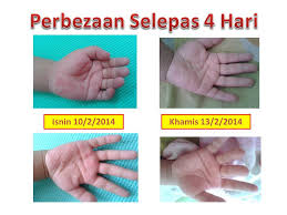 Hfmd merupakan singkatan bagi hand, foot, mouth disease. Cara Rawat Hmfd Penyakit Kaki Tangan Dan Mulut Dengan Vitamin Semulajadi Shidarahmat