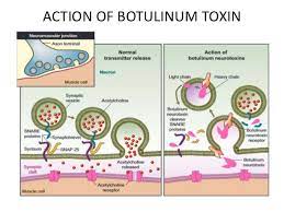 Complications of botulinum toxin and fillers: Botulinum Toxins Market Growth And Status Explored In A New Research Report Ipsen Merz Pharmaceuticals Medytox Medgadget