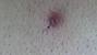 Ingrown Hair Black Bump