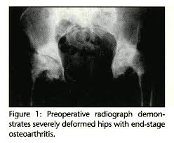 Image result for Protein C Deficiency