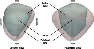 Prostate cancer is one of the most common types of cancer diagnosed in men. Computer Simulations Suggest That Prostate Enlargement Due To Benign Prostatic Hyperplasia Mechanically Impedes Prostate Cancer Growth Pnas