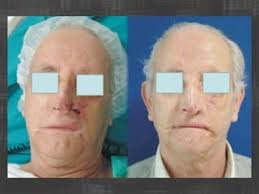 Reconstruccion nasal web