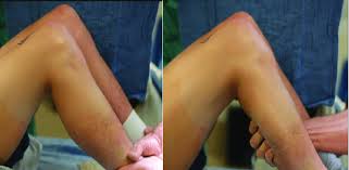 Image result for PCL Sulcus Test