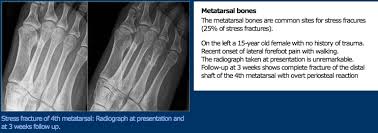 If you think you may have a stress fracture in your foot or ankle, the most important thing to do is to immediately stop all activities that cause pain. Leg And Foot Stress Fractures Physiopedia