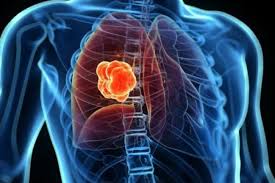 Primary lung cancer, which is quite rare and metastatic lung cancer, spread from other areas of the body. Lung Cancer Musc Health Charleston Sc