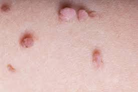 Image result for Skin Tag