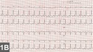 Athletes or highly fit individuals may have a normal resting heart rate of. Top 5 Arrhythmias In Dogs Cats Clinician S Brief