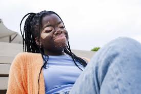 Image result for Vitiligo