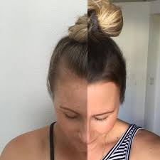 Treatment for hair thinning and loss