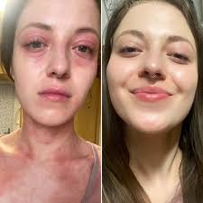 Image result for ekzema face