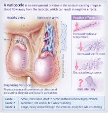 Image result for Varicocele