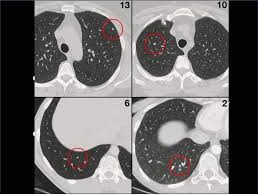 Needless to say, the sooner that it is detected, the. Where S Waldo The Challenges Of Lung Cancer Nodule Detection In Ct Lung Screenings Isct