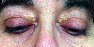 Image result for xantelasma