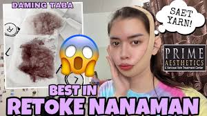 BUCCAL FAT REMOVAL NO MORE CHUBBY CHEEKS FOR THE GOOD ITEM NAK! 🤣 ||  VLOG#150 JanaLarman