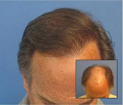 Robert james clinic only offers the best hair loss treatments in los angeles. Hair Transplant Los Angeles Dr Sean Behnam Md