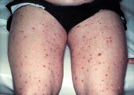 • how often do you get flares of eczema? Adult Onset Recalcitrant Eczema A Marker Of Noncutaneous Lymphoma Or Leukemia Journal Of The American Academy Of Dermatology