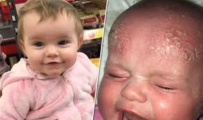 There isn't any firm evidence that avoiding certain foods while you are breastfeeding or during pregnancy will prevent your child from getting eczema (kramer and kakuma. Eczema Cured With Childs Farm Moisturiser Sold In Boots Skin Condition Gone With Treatmen Express Co Uk