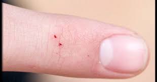 Slideshow Black Widow Spider Vs Brown Recluse Spider Emedicinehealth Spider Bites Home Health Remedies Home Remedies For Spiders