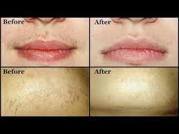 The spring epilators work best on upper lip hairs. Pin On Peau