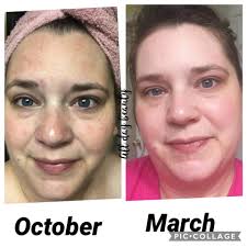 Rodan Fields skincare product results