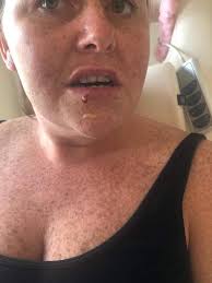 My lips exploded with pus after £60 botched fillers pierced a blood vessel  and left me permanently disfigured