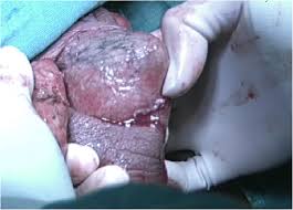 It is a true urological emergency due to the high mortality rate but fortunately, the condition is rare. Successful Treatment Following Early Recognition Of A Case Of Fournier S Scrotal Gangrene After A Perianal Abscess Debridement A Case Report Journal Of Medical Case Reports Full Text