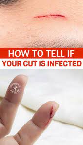Jun 07, 2018 · seek immediate medical attention if you have these signs of infection: Pin On Survival