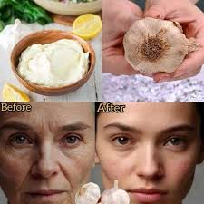 Collagen Stimulation for Wrinkle Removal Method