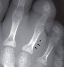 Image result for Osteomyelitis XRay