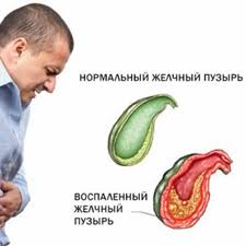 Zabolevaniya Zhelchnogo Puzyrya Simptomy I Lechenie