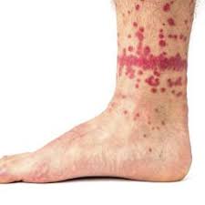 Skin Rash 68 Pictures Causes And Treatments