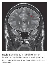 Image result for Incidental Imaging Finding