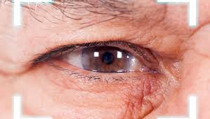 Cataracts usually develop in both eyes, but sometimes they only affect one. Crstoday Cataract Surgery After Smile