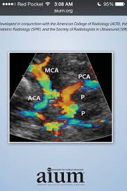 Transcranial Doppler Guidelines Aium Http Www Aium Org Resources Guidelines Transcran Ultrasound Sonography Medical Ultrasound Diagnostic Medical Sonography