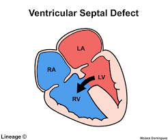Image result for Ventricular Septal Defect